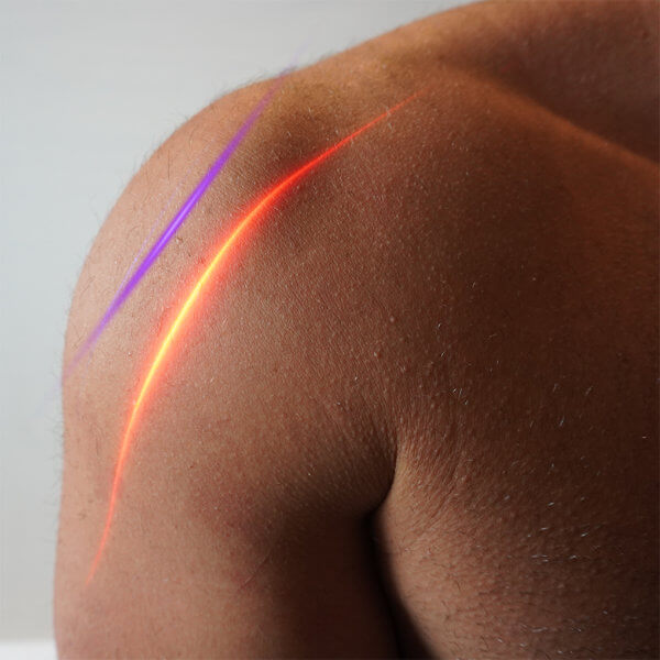 Cold lasers are used on sore muscles